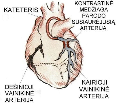 Vainikinių arterijų mikrovaskulinė disfunkcija