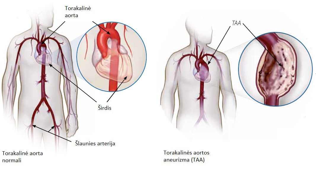 aortos aneurizmos hipertenzija