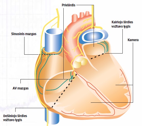 širdies ritmo sutrikimai, operacija, stimuliatorius - martynofondas.lt